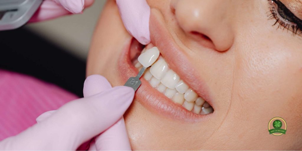 The Dental Veneers Process