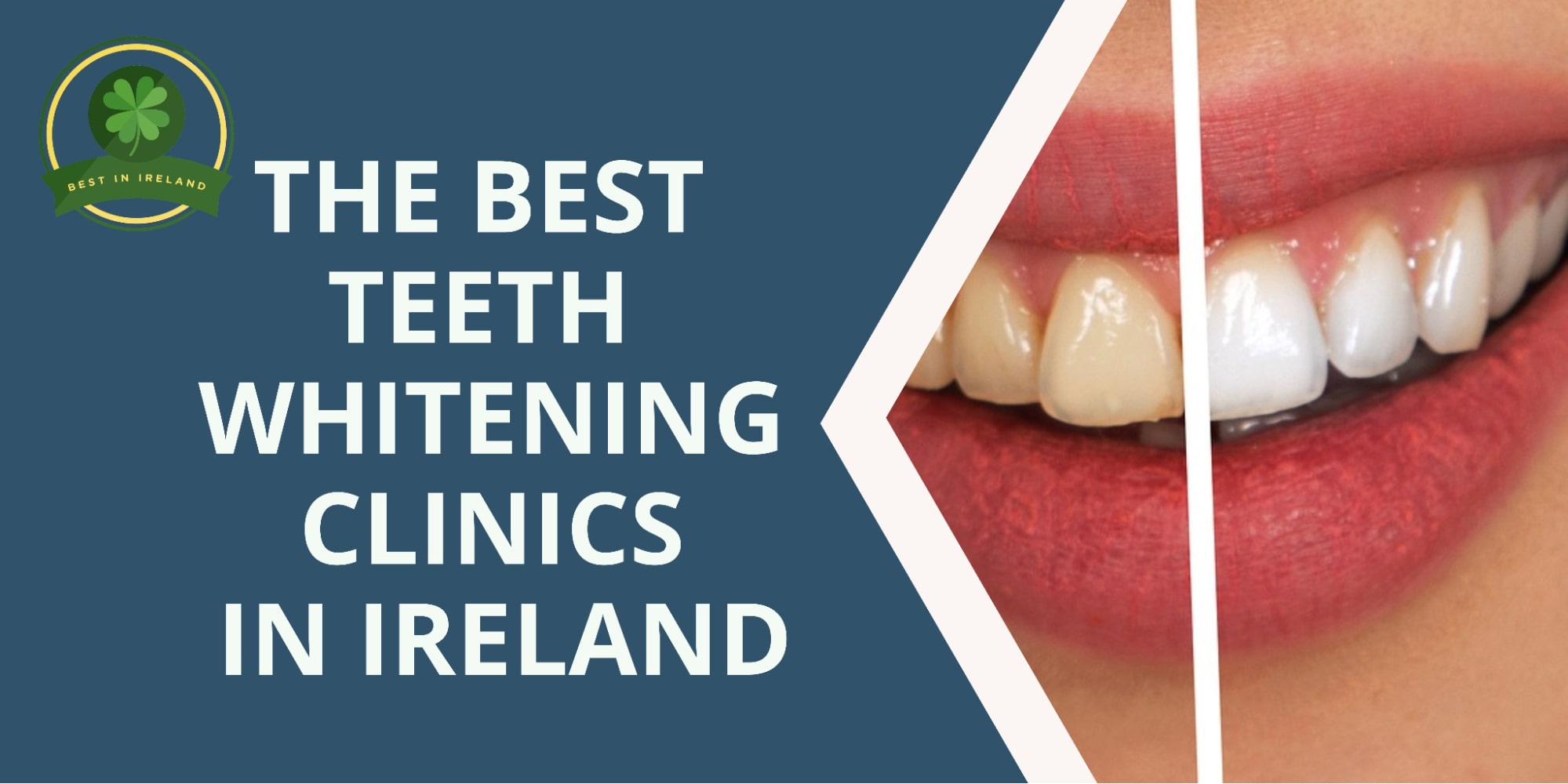 5 Best Teeth Whitening Clinics in Ireland