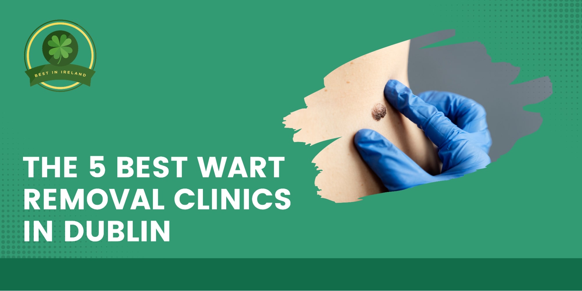 5 Best Wart Removal Clinics in Dublin